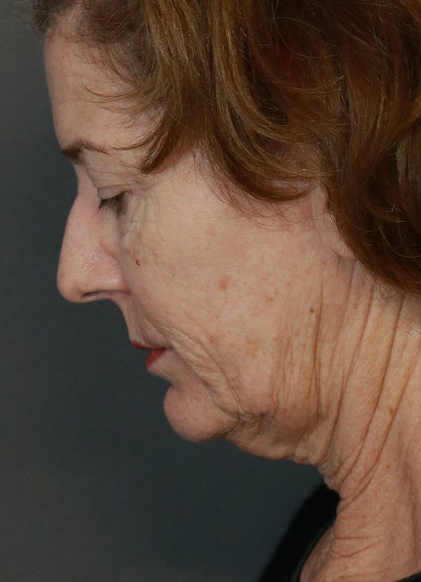 Facelift Before & After Gallery - Patient 31730255 - Image 11