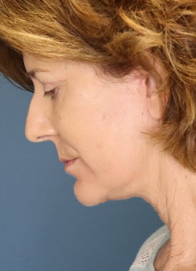 Facelift Before & After Gallery - Patient 31730255 - Image 12