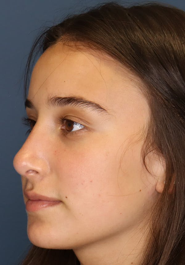 Aesthetic Rhinoplasty Before & After Gallery - Patient 31730263 - Image 4