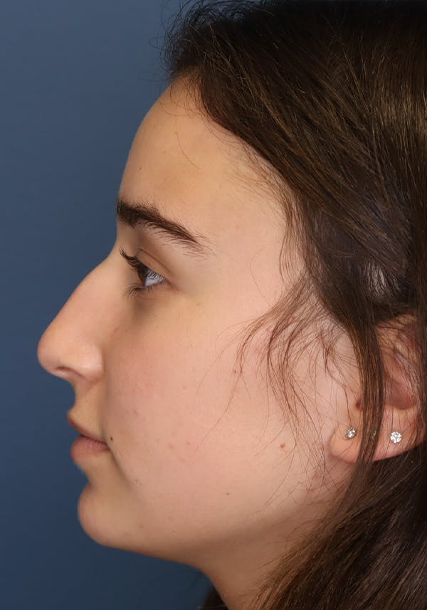 Aesthetic Rhinoplasty Before & After Gallery - Patient 31730263 - Image 5