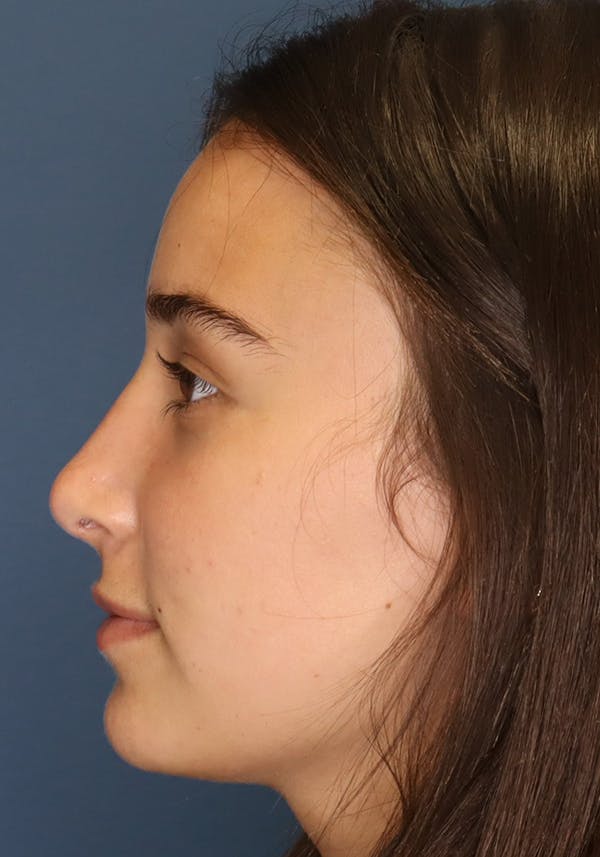 Aesthetic Rhinoplasty Before & After Gallery - Patient 31730263 - Image 6
