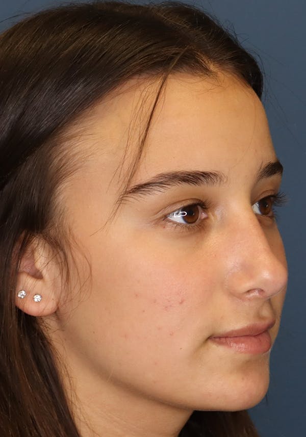 Aesthetic Rhinoplasty Before & After Gallery - Patient 31730263 - Image 8