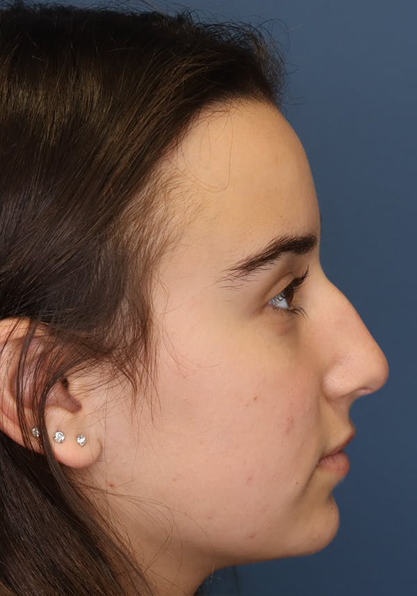 Aesthetic Rhinoplasty Before & After Gallery - Patient 31730263 - Image 9