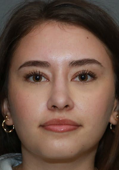 Aesthetic Rhinoplasty Before & After Gallery - Patient 32588683 - Image 2
