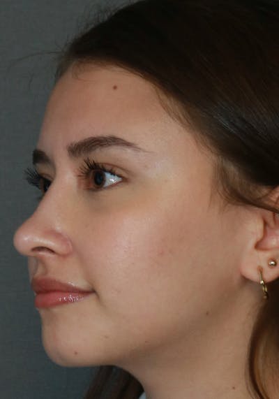 Aesthetic Rhinoplasty Before & After Gallery - Patient 32588683 - Image 4