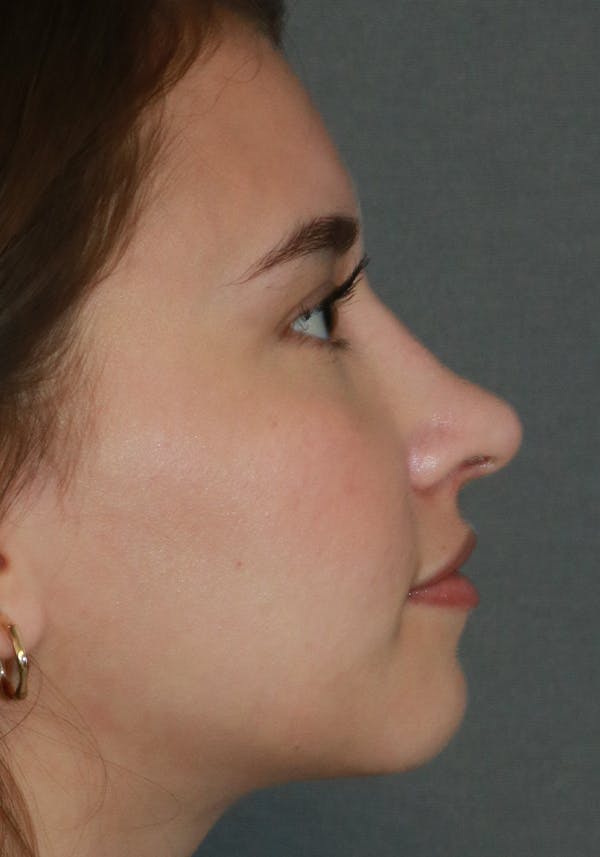 Aesthetic Rhinoplasty Before & After Gallery - Patient 32588683 - Image 10