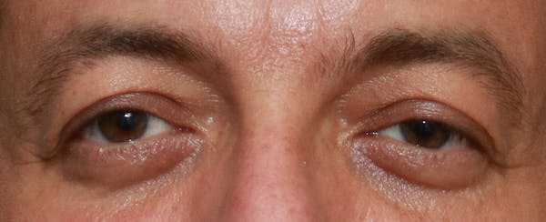 Upper Blepharoplasty Before & After Gallery - Patient 32588702 - Image 1