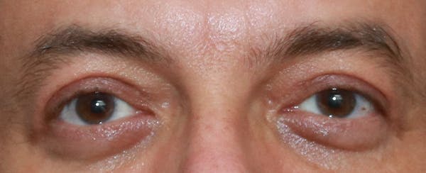 Upper Blepharoplasty Before & After Gallery - Patient 32588702 - Image 2