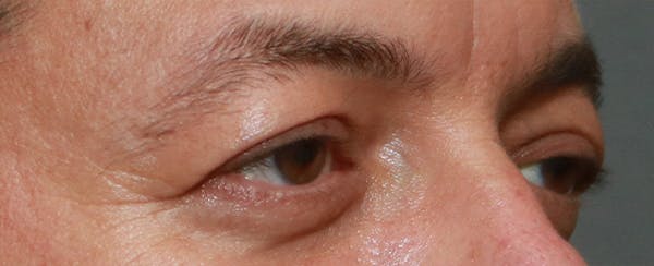 Upper Blepharoplasty Before & After Gallery - Patient 32588702 - Image 3