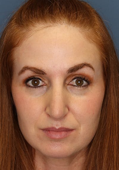 Aesthetic Rhinoplasty Before & After Gallery - Patient 35802290 - Image 1