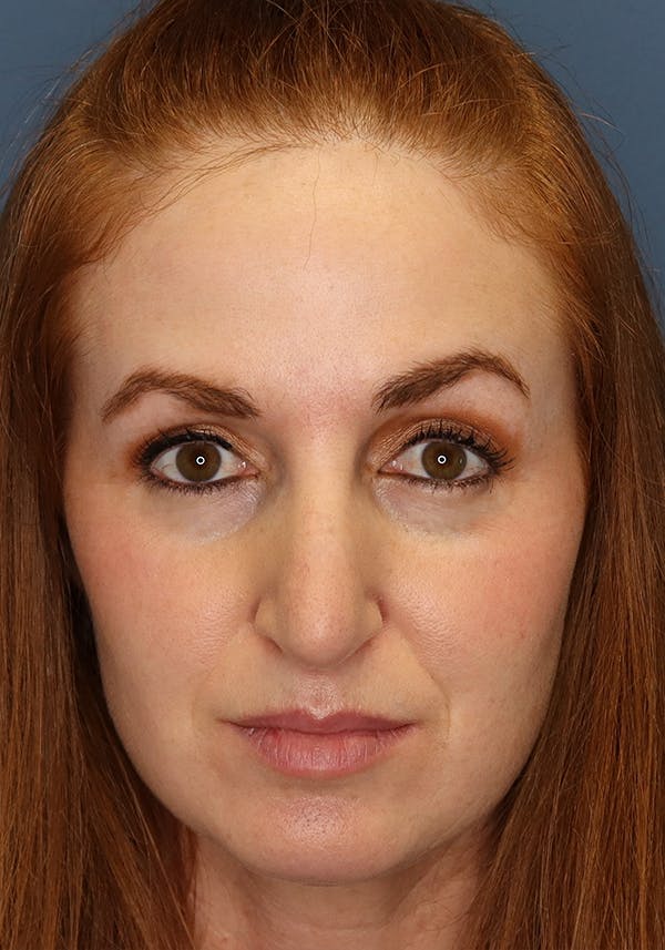 Aesthetic Rhinoplasty Before & After Gallery - Patient 35802290 - Image 1
