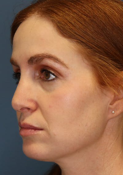 Aesthetic Rhinoplasty Before & After Gallery - Patient 35802290 - Image 4
