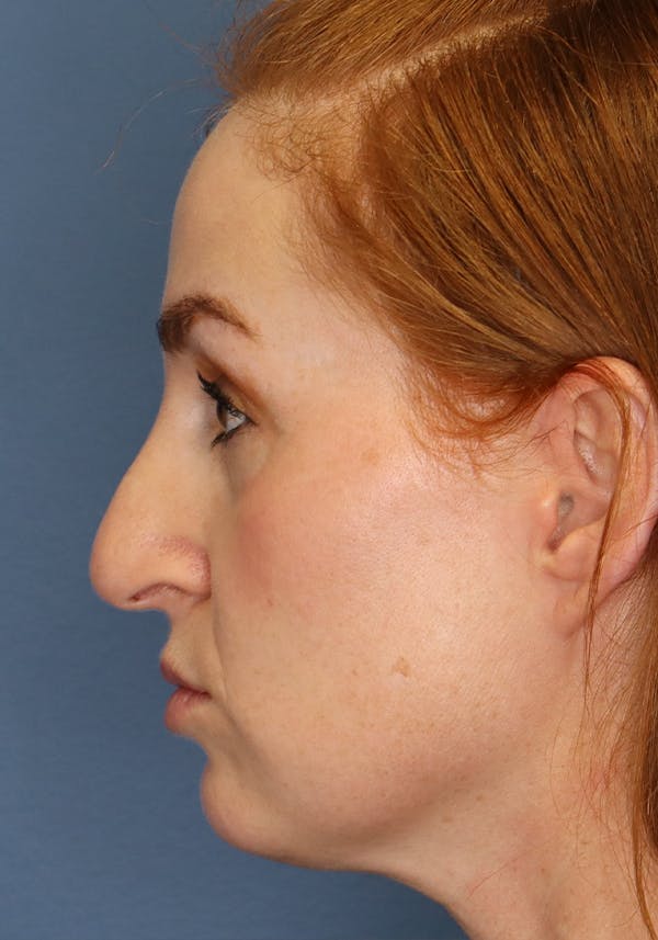 Aesthetic Rhinoplasty Before & After Gallery - Patient 35802290 - Image 5