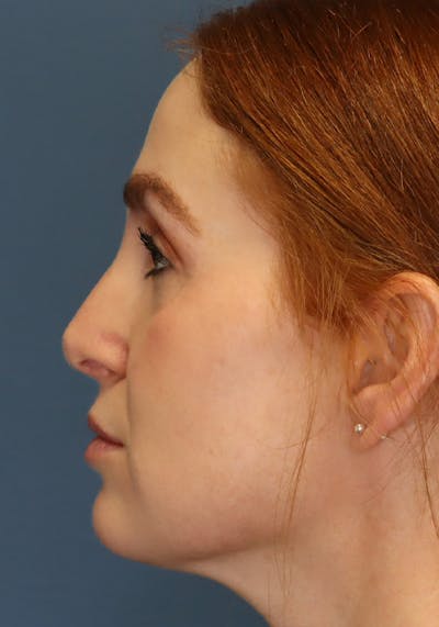 Aesthetic Rhinoplasty Before & After Gallery - Patient 35802290 - Image 6