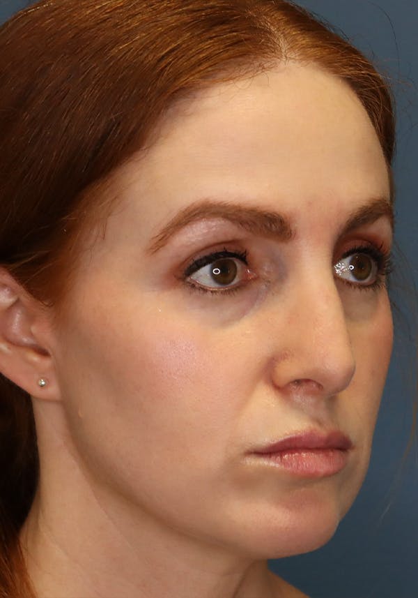 Aesthetic Rhinoplasty Before & After Gallery - Patient 35802290 - Image 8