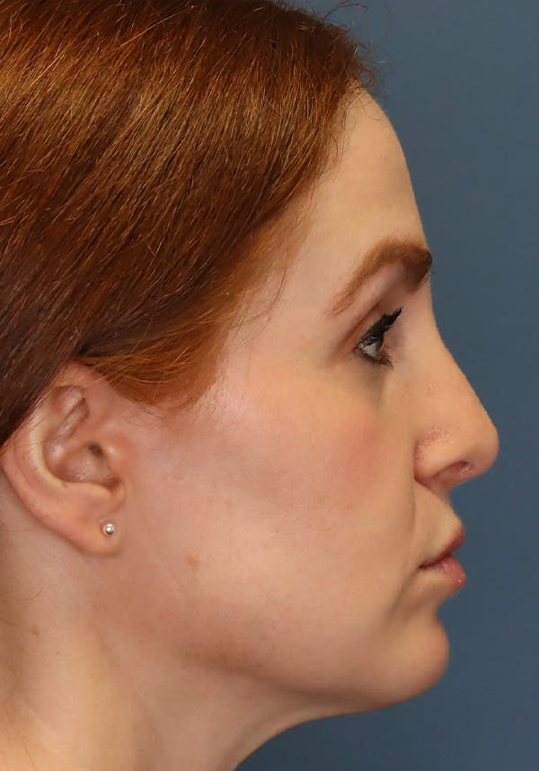 Aesthetic Rhinoplasty Before & After Gallery - Patient 35802290 - Image 10