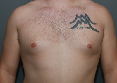 Gynecomastia Before & After Gallery - Patient 35803975 - Image 1