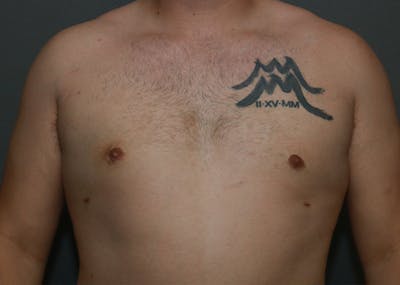 Gynecomastia Before & After Gallery - Patient 35803975 - Image 2