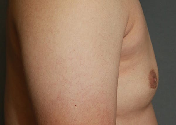 Gynecomastia Before & After Gallery - Patient 35803980 - Image 6