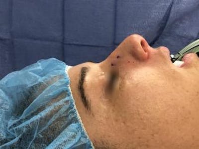 Functional Rhinoplasty Before & After Gallery - Patient 37535477 - Image 1