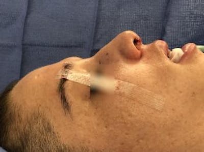 Functional Rhinoplasty Before & After Gallery - Patient 37535477 - Image 2
