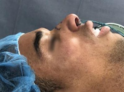 Functional Rhinoplasty Before & After Gallery - Patient 37535478 - Image 1