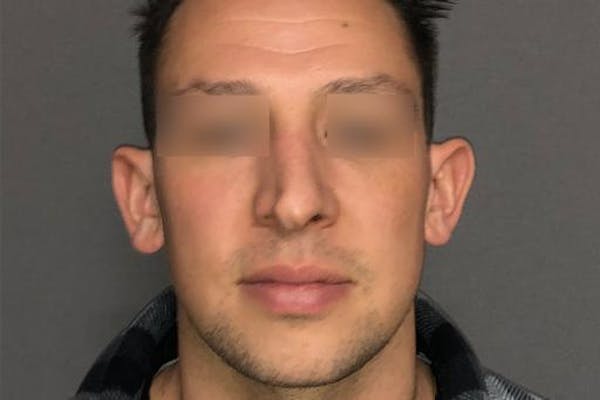 Functional Rhinoplasty Before & After Gallery - Patient 37535479 - Image 1