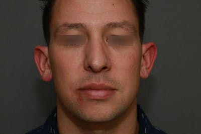Functional Rhinoplasty Before & After Gallery - Patient 37535479 - Image 2