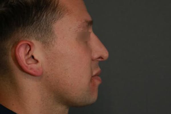 Functional Rhinoplasty Before & After Gallery - Patient 37535479 - Image 4