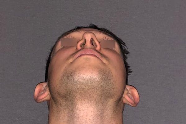 Functional Rhinoplasty Before & After Gallery - Patient 37535479 - Image 5