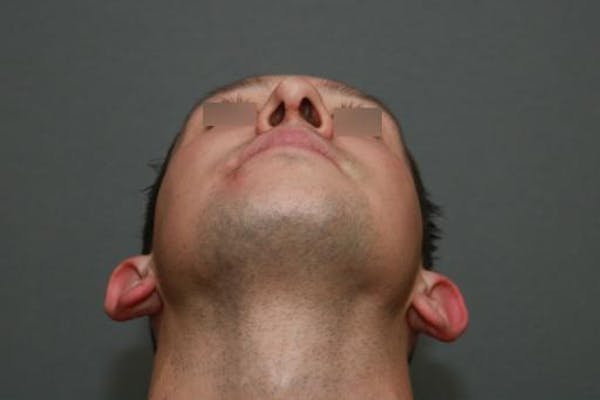 Functional Rhinoplasty Before & After Gallery - Patient 37535479 - Image 6