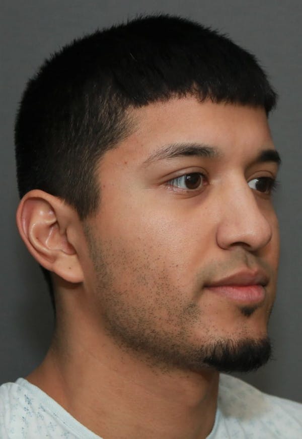 Functional Rhinoplasty Before & After Gallery - Patient 37535480 - Image 3