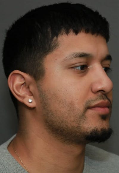 Functional Rhinoplasty Before & After Gallery - Patient 37535480 - Image 4