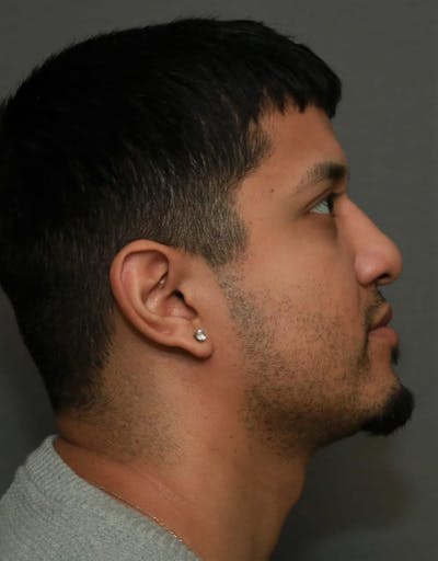 Functional Rhinoplasty Before & After Gallery - Patient 37535480 - Image 6