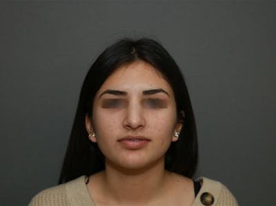Aesthetic Rhinoplasty Before & After Gallery - Patient 37536268 - Image 2