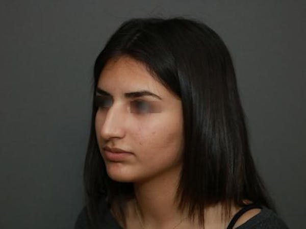 Aesthetic Rhinoplasty Before & After Gallery - Patient 37536268 - Image 3