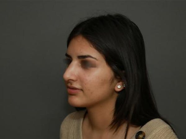 Aesthetic Rhinoplasty Before & After Gallery - Patient 37536268 - Image 4