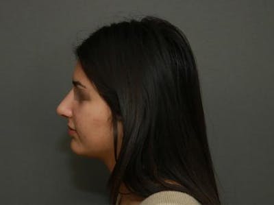 Aesthetic Rhinoplasty Before & After Gallery - Patient 37536268 - Image 6