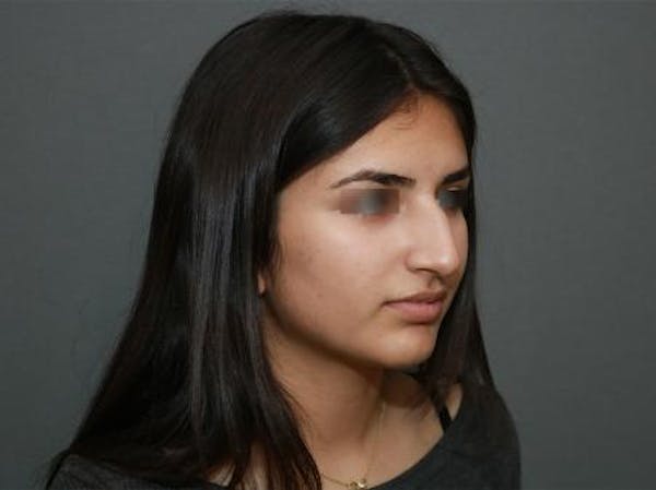 Aesthetic Rhinoplasty Before & After Gallery - Patient 37536268 - Image 7