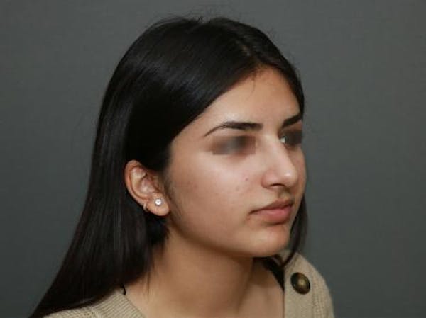 Aesthetic Rhinoplasty Before & After Gallery - Patient 37536268 - Image 8