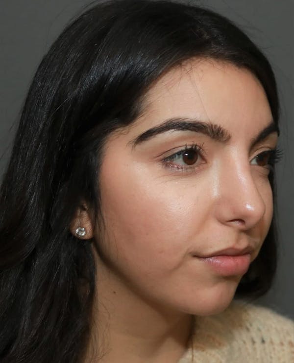 Aesthetic Rhinoplasty Before & After Gallery - Patient 37536273 - Image 4