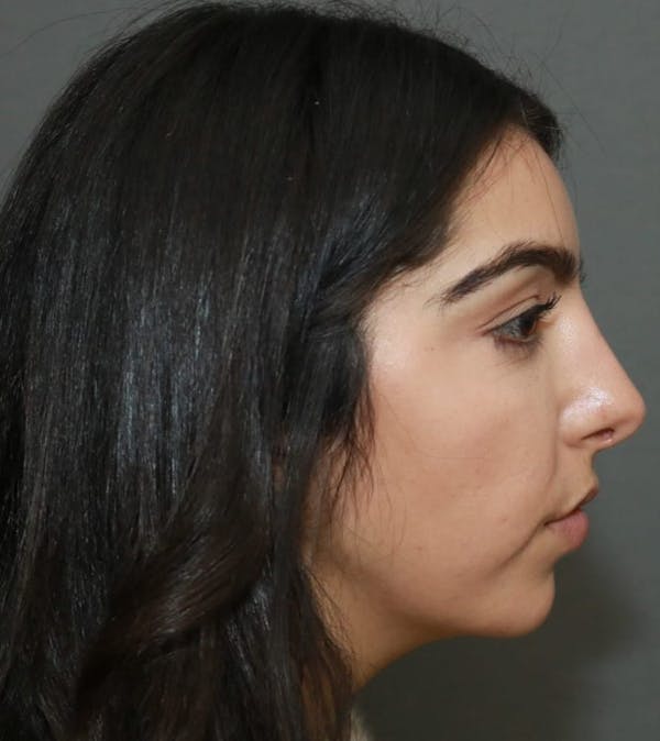 Aesthetic Rhinoplasty Before & After Gallery - Patient 37536273 - Image 6