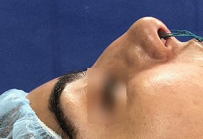 Aesthetic Rhinoplasty Before & After Gallery - Patient 37536274 - Image 1