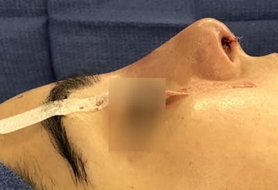 Aesthetic Rhinoplasty Before & After Gallery - Patient 37536274 - Image 2