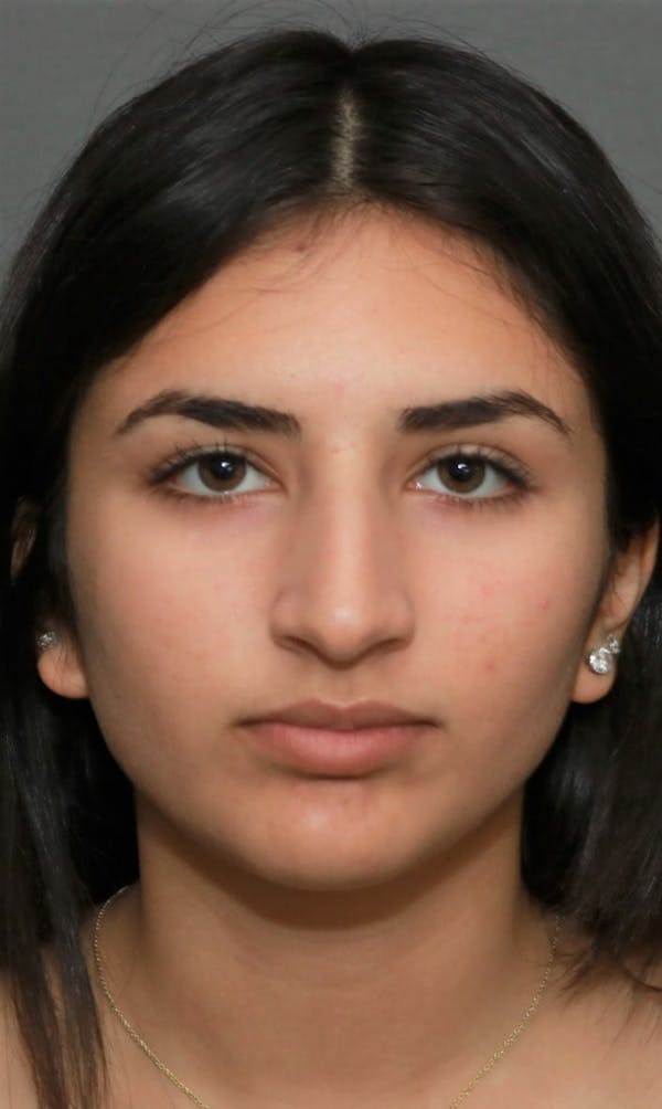 Aesthetic Rhinoplasty Before & After Gallery - Patient 37536317 - Image 1