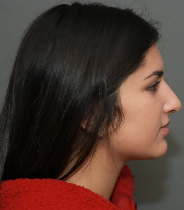 Aesthetic Rhinoplasty Before & After Gallery - Patient 37536317 - Image 6