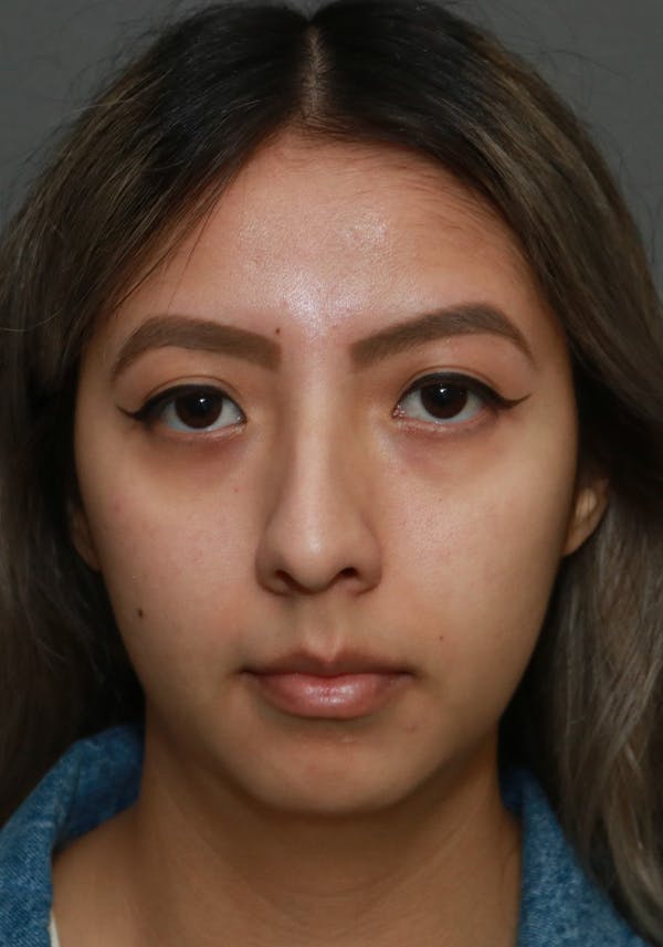 Aesthetic Rhinoplasty Before & After Gallery - Patient 37536322 - Image 1
