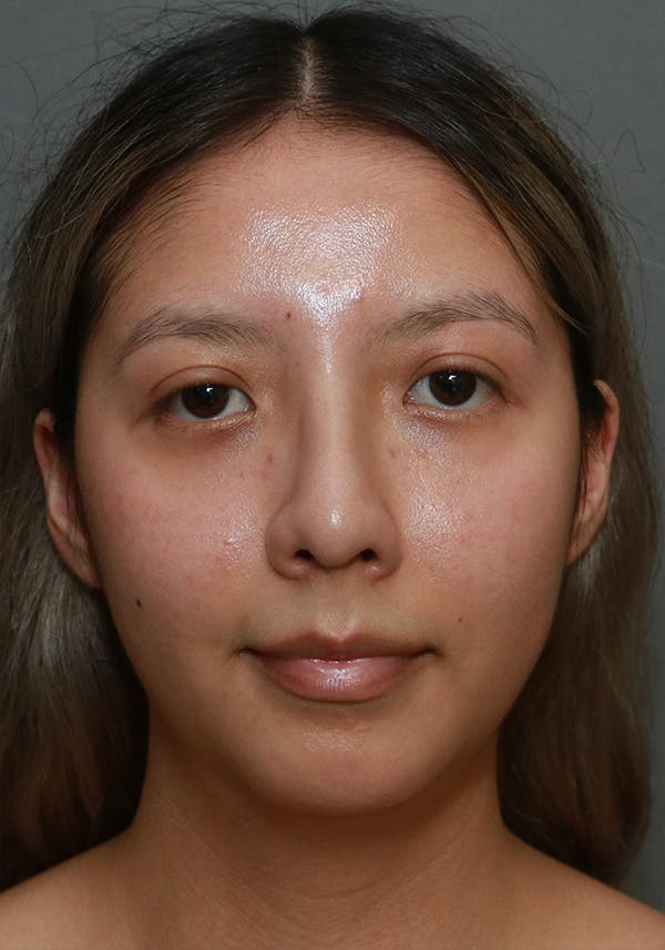 Aesthetic Rhinoplasty Before & After Gallery - Patient 37536322 - Image 2