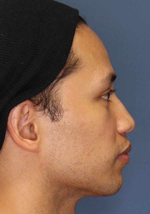 Aesthetic Rhinoplasty Before & After Gallery - Patient 37536323 - Image 5