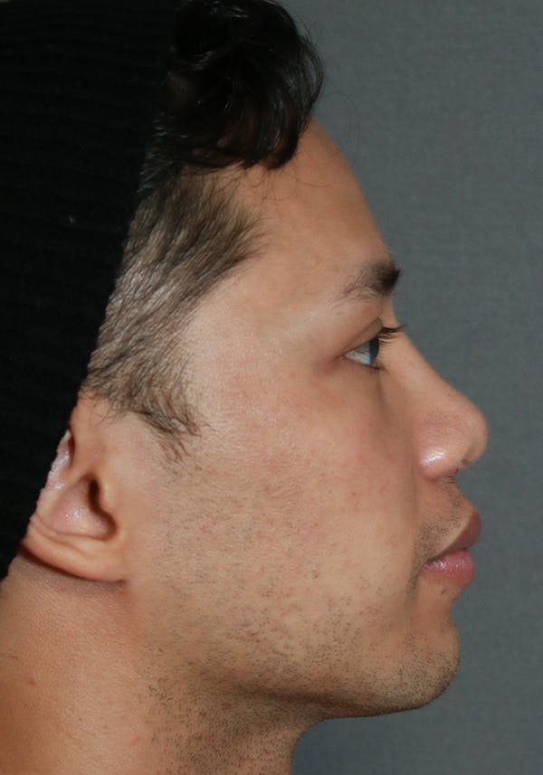 Aesthetic Rhinoplasty Before & After Gallery - Patient 37536323 - Image 6